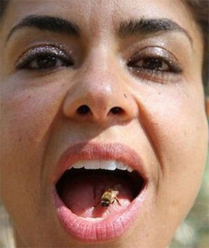 botox